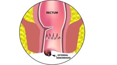 علاج البواسير في المنزل..استعمال أكياس الثلج لتقليل التورم