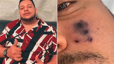 لدغة عنكبوت تنهي حياة المغني البرازيلي دارلين مورايس