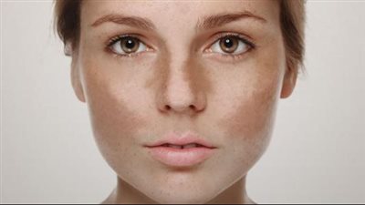 أسباب الكلف عند البنات.. 5 عوامل محفزة على الإصابة بخلاف الحمل