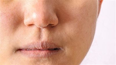 أسباب جفاف وخشونة الوجه.. علامات وعلاجات انتبهي لها جيدًا