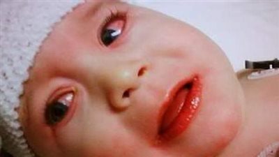 مرض كاواساكي للأطفال.. عدوى فيروسية خطيرة تصيب الصغار بهذه الأعراض