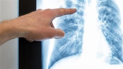 متلازمة الضائقة التنفسية الحادة تهدد الحياة.. ما القصة؟