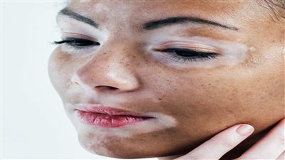 في المنزل.. أسرع طريقة لعلاج البهاق دون تعب