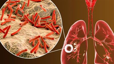 الدرن الرئوي.. ما هي أعراضه؟