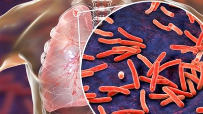 الفئات المعرضة للدرن الرئوي.. من هم؟