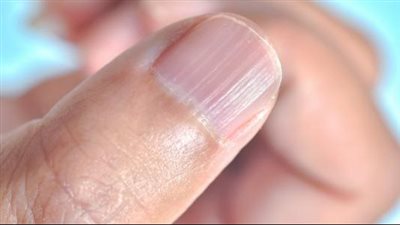 أعراض نقص الزنك عند النساء.. 10 علامات مهمة انتبهي لها