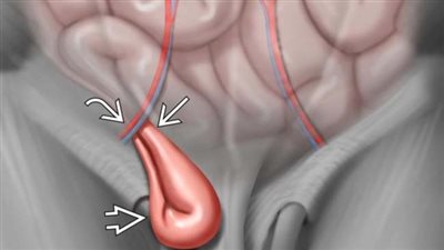ما هو الفتق الإربي؟ وهل يمكن الشفاء منه دون جراحة؟