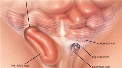 أسباب الإصابة بالفتق الإربي.. خلقية ومكتسبة