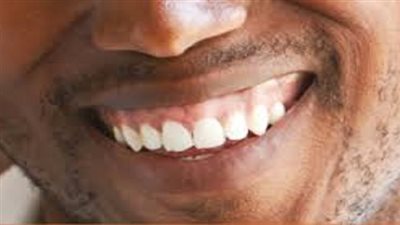 ما سبب ظهور اللثة عند الضحك؟.. قصر طول التاج