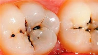 متى نسحب عصب الضرس؟.. التسوس العميق أبرز الأسباب