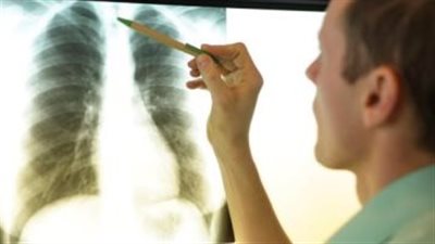 مرض مُعقّد.. كل ما تود معرفته الالتهاب الرئوي الخلالي مجهول السبب