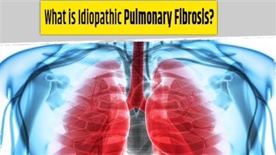 هل يوجد علاج لـ تليف الرئة المجهول السبب؟