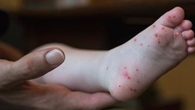 هل الحمى القلاعية معدية للإنسان؟.. نادرة لكنها تحدث