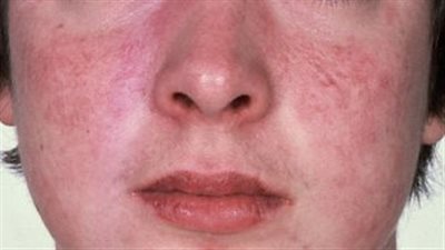 مرض الذئبة.. التعريف والأسباب والأعراض والعلاج