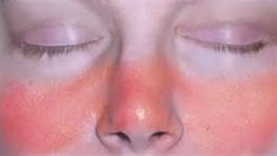 كيف يُمكن علاج مرض الذئبة بطريقة سريعة؟