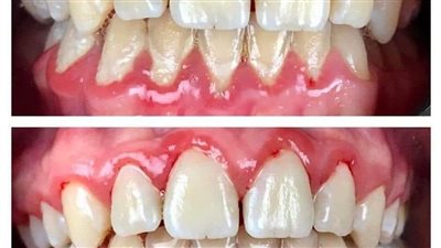 التهاب دواعم الأسنان؟.. ما اسبابه وأعراضه؟
