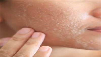 ماذا تعرف عن مرض جفاف الجلد المصطبغ؟