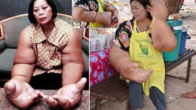 اضطراب نادر ووراثي.. ما خطورة متلازمة بروتيس؟