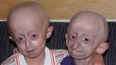 الشيخوخة المبكرة.. كل ما تود معرفته عن 