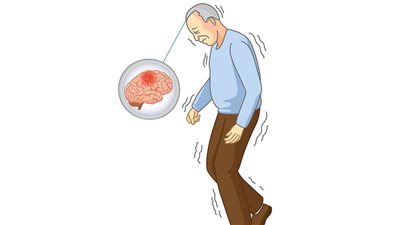 ما هي أمراض الترنح الشائعة؟