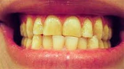 أسباب صفار الأسنان لدى النساء.. منها التدخين وسوء النظافة
