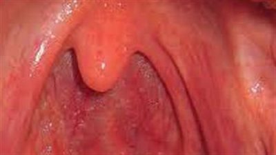 كل ما تود معرفته عن التهاب البلعوم الحاد