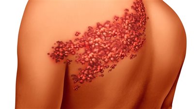 ما هو سبب ظهور الحزام الناري؟ وهل يسبب الوفاة؟