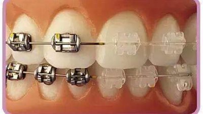 كيف أقوي اسناني بعد التقويم؟..الاهتمام بالنظافة أهم عامل
