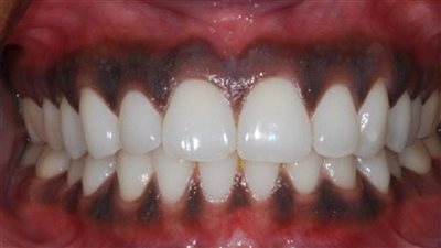 أسباب اللثة السوداء.. المدخنون يعانون أكثر من غيرهم