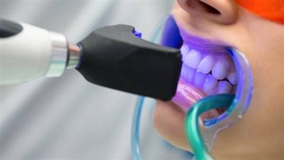 الآثار الجانبية لتبييض الأسنان بالزوم.. احذر الحساسية