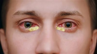 اسباب عماص العين.. انتبه للجفاف