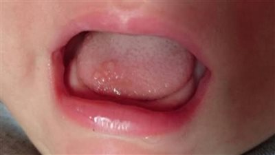 علاج الهربس الفموي لدى الأطفال.. تجنبى الحامضيات 