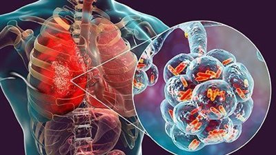 ما هي أسباب للتهاب الرغامى الجرثومي البكتيري؟