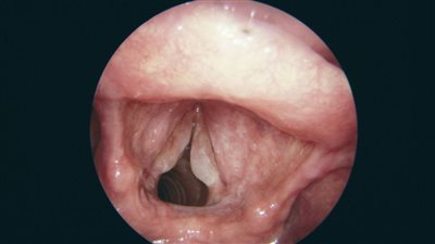 هل يوجد علاج للالتهاب الرغامى الجرثومي البكتيري؟