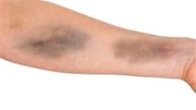 أسباب البقع الزرقاء على جسم المرأة.. ️الضغط النفسى له تأثير كبير