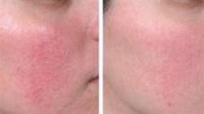 ما أسباب احمرار الوجه؟.. ارتفاع درجة حرارة الجسم