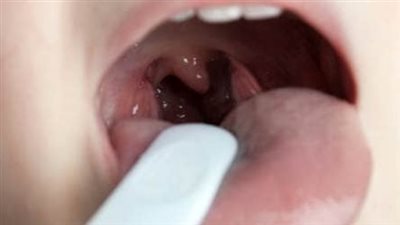 أسباب التهاب الحلق