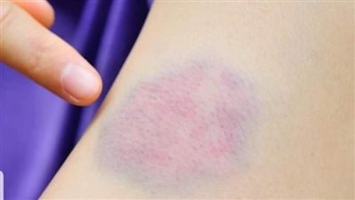 ما سبب ظهور كدمات على جسم المرأة؟ 