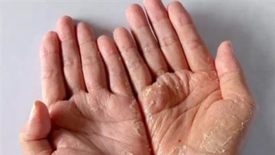  أستاذ جلدية يضع روشتة سريعة للتخلص من تشققات الشتاء (فيديو)