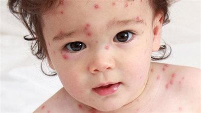 ما هو الجدري المائي ومتى يكون خطيرا؟.. 7 معلومات مهمة عن المرض