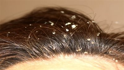 أسباب قشرة الشعر عند النساء وأنواعها.. احذري هذه الأمراض الجلدية