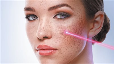 علاج النمش بالليزر.. جلسات تجميلية بالتخدير الموضعي فقط