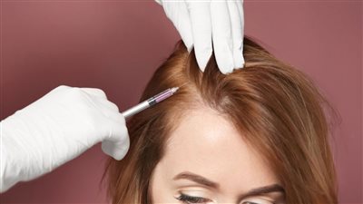 علاج الصلع للنساء بـ 4 تقنيات تجميلية أبرزها البلازما والميزوثيرابي