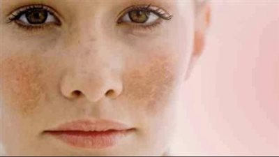 أسرع علاج للكلف.. كلمة السر في الليزر الكربوني والفراكشنال ليزر