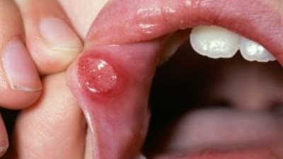 طرق علاج تقرحات الفم منزليا 