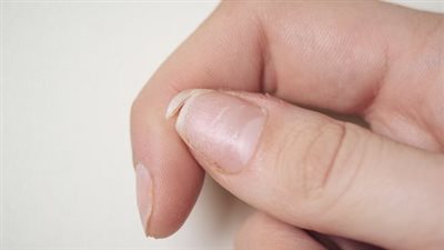 ما أسباب تقصف الاظافر؟.. السر قد يكون فى مطبخك