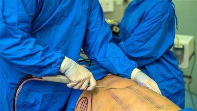 الدومينيكان.. مقبرة الأمريكان خلال عمليات التجميل وشفط الدهون