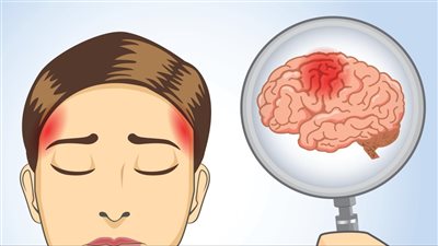 أخطر أنواع الصداع وأسبابه.. 9 علامات تحذيرية أبرزها زغللة العين والقيء