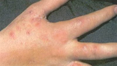 ما هي أشهر الأمراض الجلدية التي تصيب العضو الذكرى؟