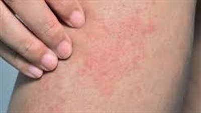 أسباب الحكة الليلية.. متلازمة تململ الساقين أشهرها